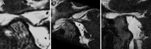 Névralgie du trijumeau — figure 2
