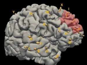 Schéma 3D projet de cortectomie