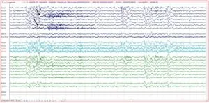 Tracé EEG de surface