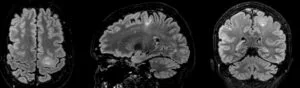 Dysplasie corticale focale - imagerie
