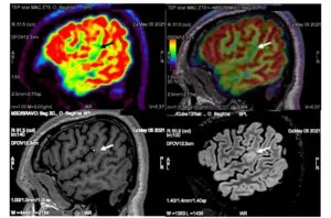 IRM et TEP dysplasie corticale focale