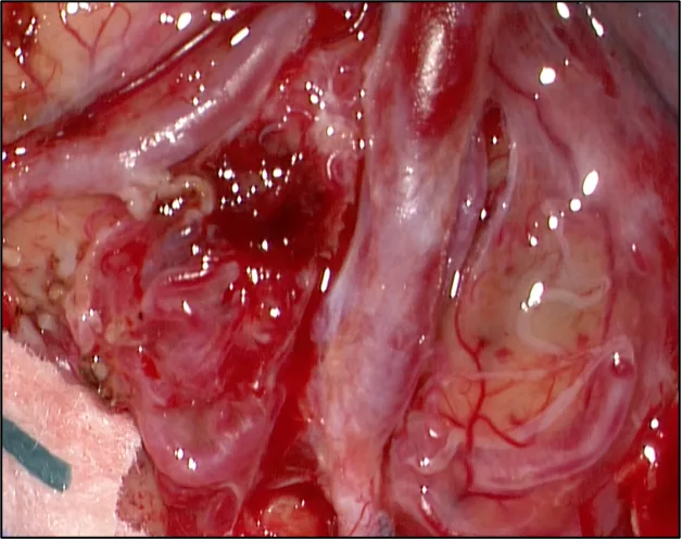 Malformation artério-veineuse cérébrale — schéma 2