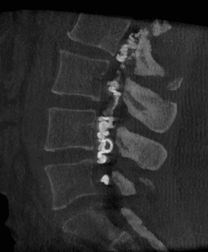 Arteriography of a spinal vascular malformation