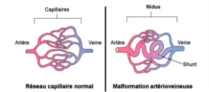 Malformation artério-veineuse cérébrale — schéma 1