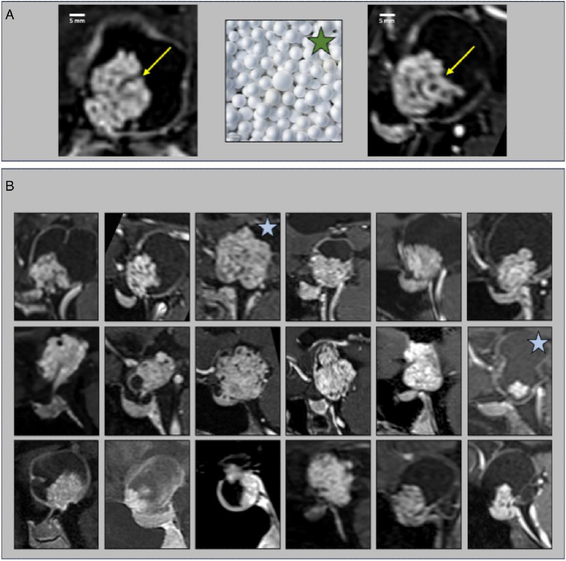 Typical appearance of the polystyrene beads sign on MRI