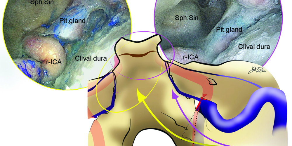 Hybrid Antero-Lateral Transcondylar Approach to the Clivus: A Laboratory Investigation and Case Illustration &#8211; Acta Neurochirurgica (2020)