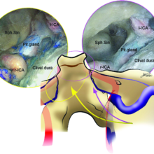 Hybrid Antero-Lateral Transcondylar Approach to the Clivus: A Laboratory Investigation and Case Illustration – Acta Neurochirurgica (2020)