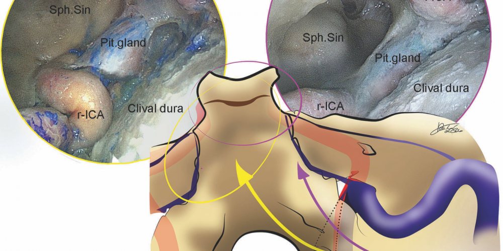 Hybrid Antero-Lateral Transcondylar Approach to the Clivus: A Laboratory Investigation and Case Illustration &#8211; Acta Neurochirurgica (2020)