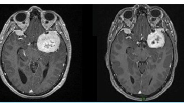 Our new publication in Acta Neurochirurgica : Spontaneous regression of meningiomas after interruption of nomegestrol acetate: a series of three patients.