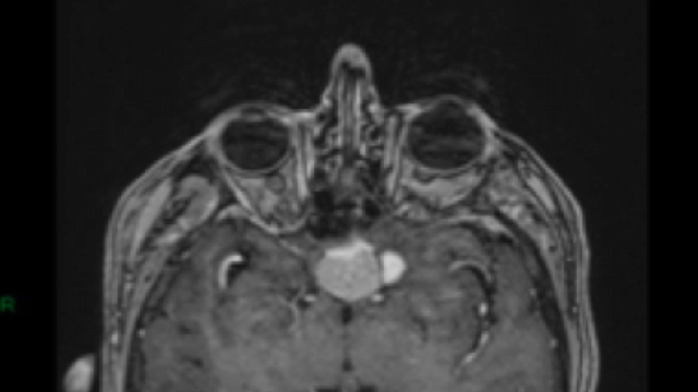 Spontaneous regression of meningiomas after interruption of nomegestrol acetate: a series of three patients.