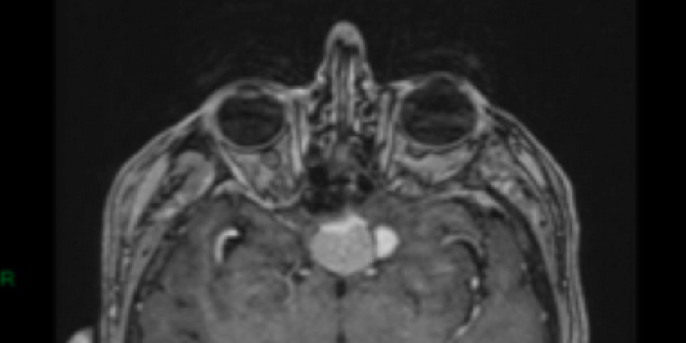 Spontaneous regression of meningiomas after interruption of nomegestrol acetate: a series of three patients.
