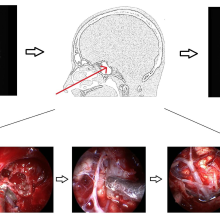 Vertebrobasilar Artery Encasement by Skull Base Chordomas: Surgical Outcome and Management Strategies – Operative Neurosurgery April 2020