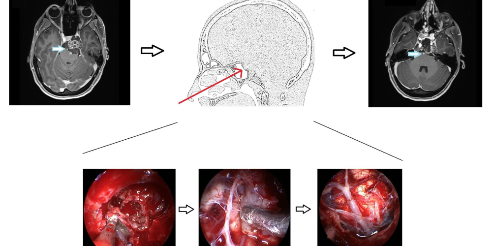 Vertebrobasilar Artery Encasement by Skull Base Chordomas: Surgical Outcome and Management Strategies &#8211; Operative Neurosurgery April 2020