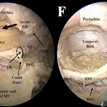 Endoscopic endonasal approach to the mesial temporal lobe: anatomical study and clinical considerations for a selective amygdalohippocampectomy – Acta Neurochirurgica December 2019