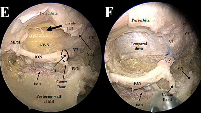 Endoscopic endonasal approach to the mesial temporal lobe: anatomical study and clinical considerations for a selective amygdalohippocampectomy – Acta Neurochirurgica December 2019