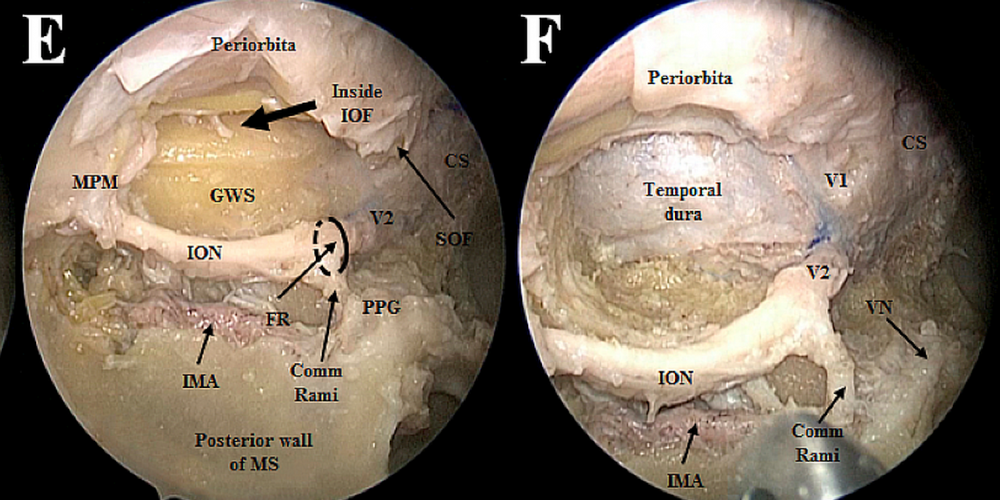 Endoscopic endonasal approach to the mesial temporal lobe: anatomical study and clinical considerations for a selective amygdalohippocampectomy &#8211; Acta Neurochirurgica December 2019