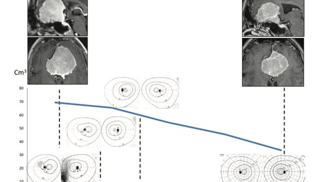 Regression of Giant Olfactory Groove Meningioma and Complete Visual Acuity Recovery after Discontinuation of Cyproterone Acetate.
