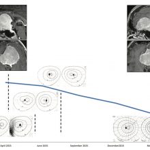 Regression of Giant Olfactory Groove Meningioma and Complete Visual Acuity Recovery after Discontinuation of Cyproterone Acetate.