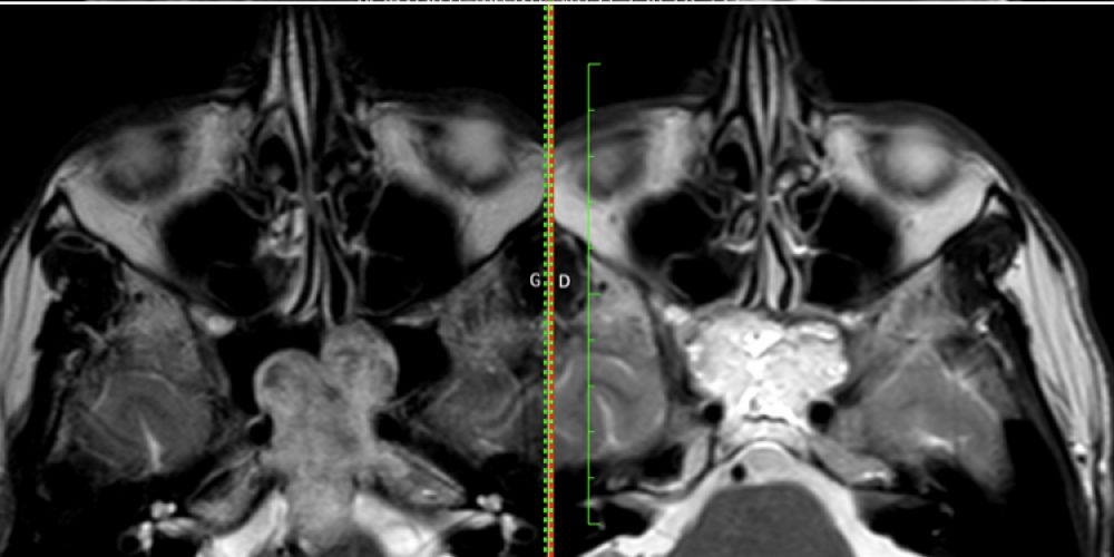 The Rostral Mucosa: The Door to Open and Close for Targeted Endoscopic Endonasal Approaches to the Clivus