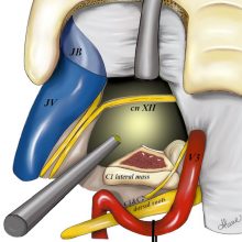 Endoscope-assisted far-lateral transcondylar approach for craniocervical junction chordomas: a retrospective case series and cadaveric dissection