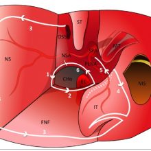 New Publication from Our Group: Combined Nasoseptal and Inferior Turbinate Flap for Reconstruction of Large Skull Base Defect After Expanded Endonasal Approach