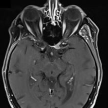 Resection of an Optic Canal Meningioma through a Contralateral Subfrontal Approach with Endoscopic Assistance: A 2D Operative Video.  Labidi M, Watanabe K, Bernat AL, Hanakita S, Froelich S